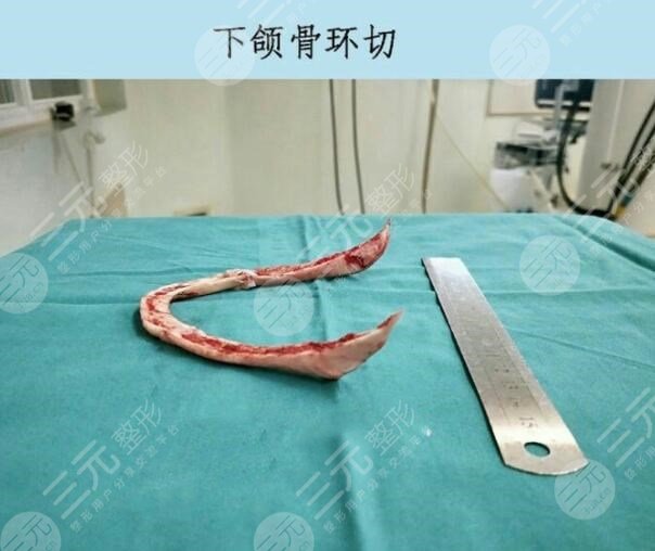 下頜角磨骨