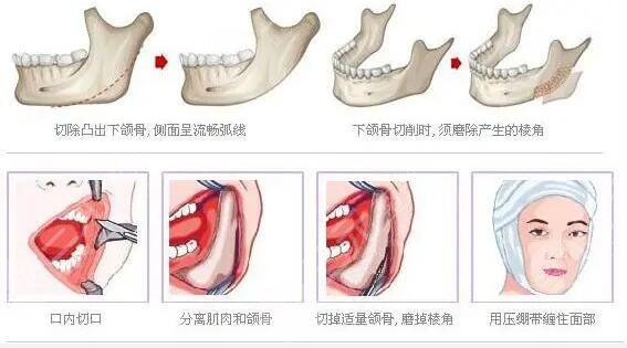 磨骨成好嗎