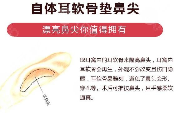 鼻尖縮小手術原理