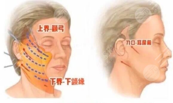 內(nèi)窺鏡拉皮手術(shù)果
