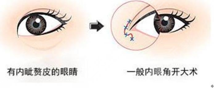 雙眼皮手術(shù)