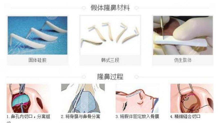 隆鼻