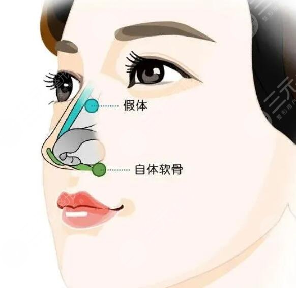 李長賦做鼻子10萬夠嗎？李長賦隆鼻技術(shù)怎么樣？隆鼻項目科普