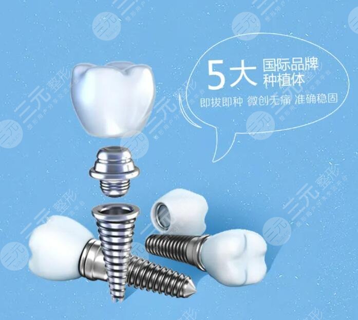 種植牙價格的影響因素