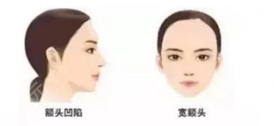 填充額頭