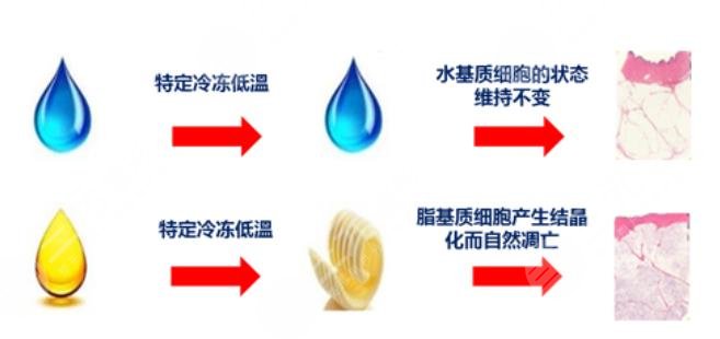 酷塑冷凍減脂
