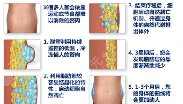 酷塑冷凍減脂