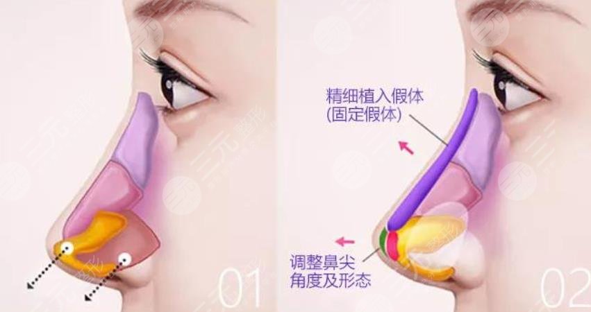 天津隆鼻整形多少錢(qián)？2W隆鼻真實(shí)案例,果對(duì)比圖