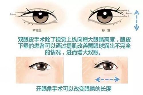 開眼角對比果圖文講解！前后區(qū)別一覽，康康你是否需要do一下！