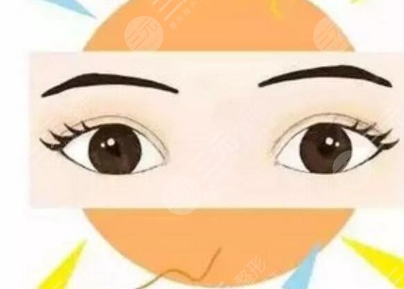 6mm平行雙眼皮案例分享