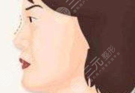 隆鼻整形日記+果反饋|成都西區(qū)鄧東偉醫(yī)生