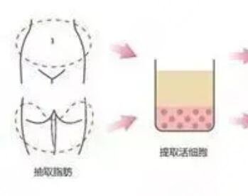 自體脂肪填充變美日記x成都悅己整形真實(shí)反饋