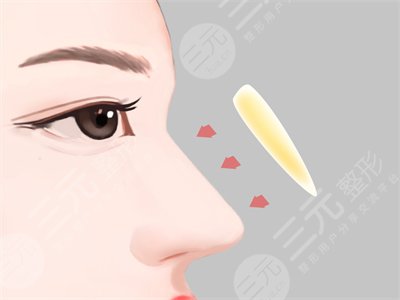 成都素美李建剛隆鼻果怎么樣？附案例真實(shí)反饋