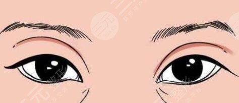 開眼角前后對(duì)比照片圖
