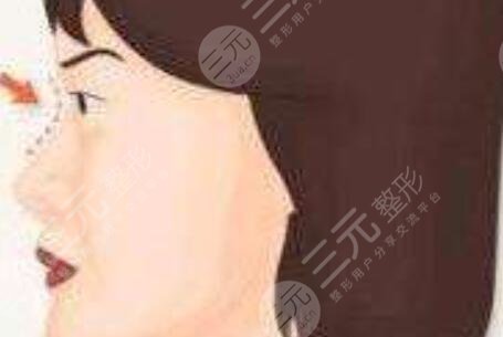 戴傳昌做鼻子案例圖片
