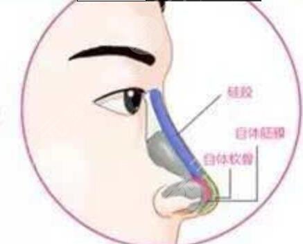 蒜頭鼻整形圖片對(duì)比