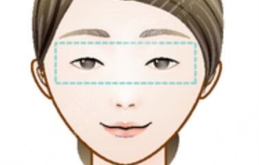 微創(chuàng)雙眼皮7天恢復(fù)圖