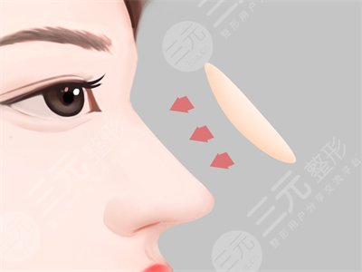 耳軟骨墊鼻尖恢復(fù)過(guò)程圖：8個(gè)月果參考一下！
