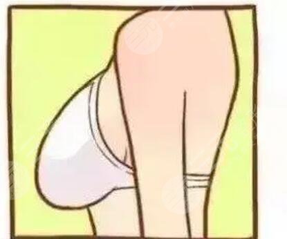 豐胸前后的圖片對比