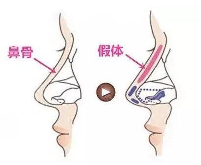 李長賦做鼻子10萬夠嗎？做鼻子多少錢？