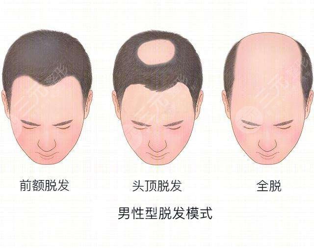 珠海雍禾植發(fā)醫(yī)院禿頂植發(fā)案例分享