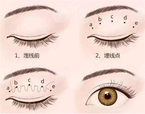 江蘇省中醫(yī)院雙眼皮術(shù)后