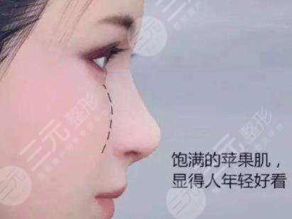 自體脂肪填充蘋果肌多久恢復自然