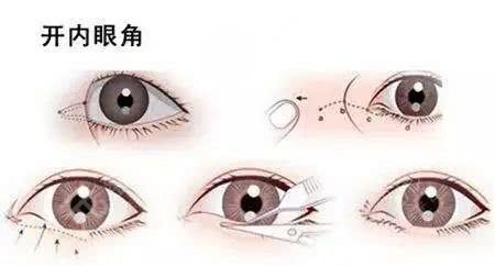 開眼角手術和不開眼角的區(qū)別