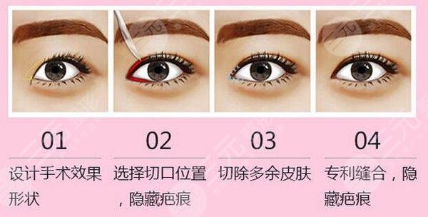 開眼角手術和不開眼角的區(qū)別