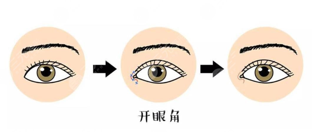 開眼角手術和不開眼角的區(qū)別