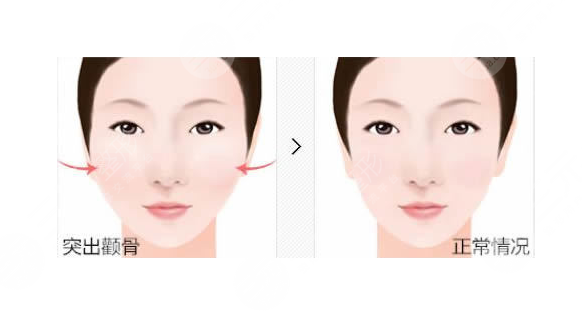 抽脂瘦臉手術(shù)案例術(shù)后1周