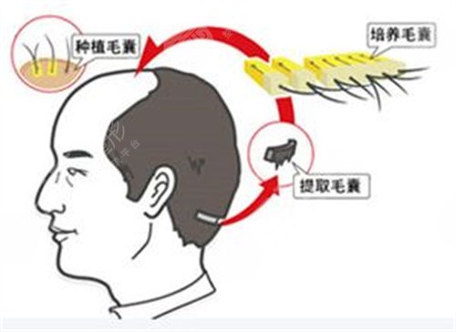 植發(fā)術(shù)后注意事項(xiàng)