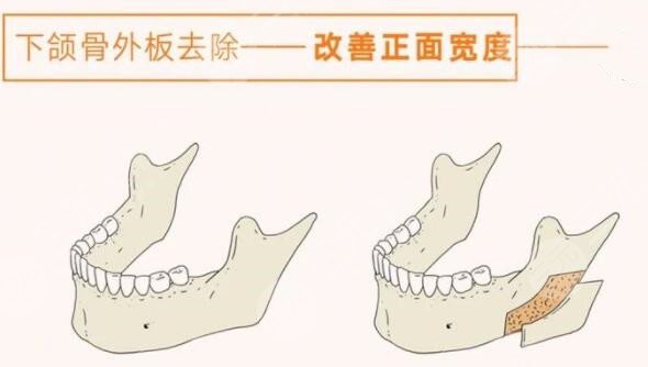 磨下頜角手術(shù)過程圖恢復記錄，真人下頜角磨骨對比圖~
