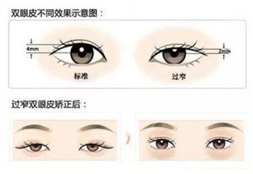 張誠教授做眼修復(fù)案例,7天get自然靈動大雙眼