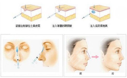 射頻除皺后一個月