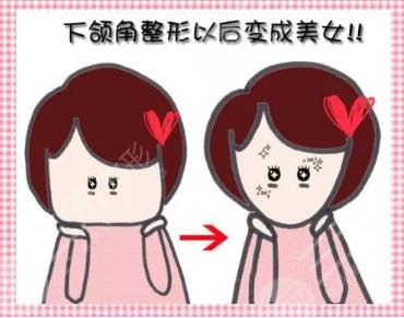 上海華美下頜角真人案例對(duì)比