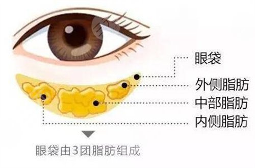 微創(chuàng)去眼袋一般適合什么年齡？任何年齡都可以做這項(xiàng)目嗎？