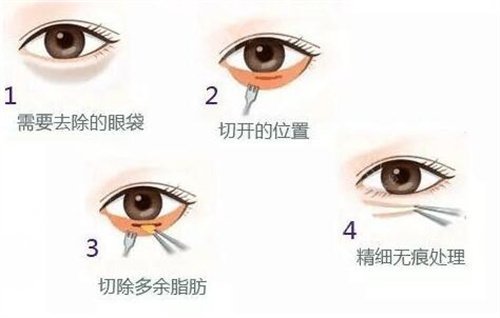 微創(chuàng)去眼袋一般適合什么年齡？任何年齡都可以做這項(xiàng)目嗎？