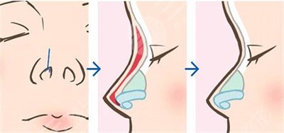 硅膠假體和膨體隆鼻果怎么樣?哪個(gè)好?多少錢(qián)?