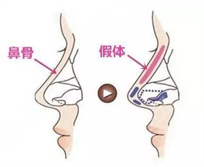 硅膠假體和膨體隆鼻果怎么樣?哪個(gè)好?多少錢(qián)?