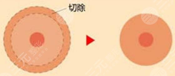 乳暈縮小手術(shù)后的護(hù)理事項(xiàng)是什么?