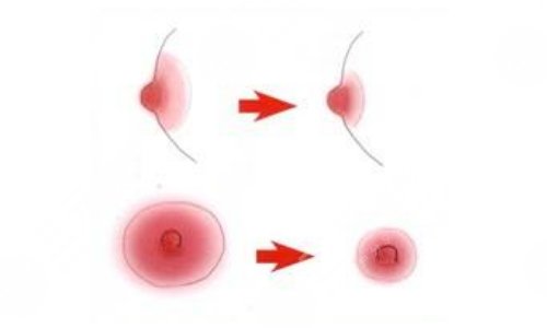 乳暈縮小手術(shù)有什么危害？手術(shù)費(fèi)用、優(yōu)點(diǎn)、術(shù)后護(hù)理盤點(diǎn)！