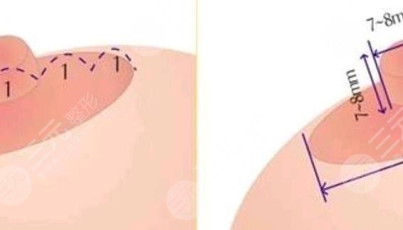 乳暈縮小手術(shù)的危害是什么?