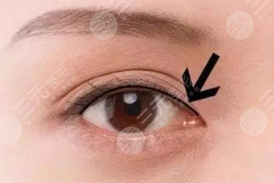 美瞳線(xiàn)一到七天恢復(fù)過(guò)程圖