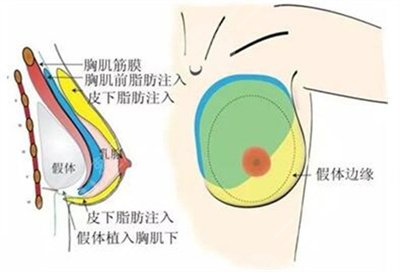 c罩杯多大胸圖片欣賞丨胸部整形手術(shù)之后需要注意什么？