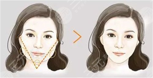 面部吸脂案例