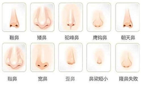 九院王濤隆鼻怎么樣？案例分享丨**改造我的塌鼻子！