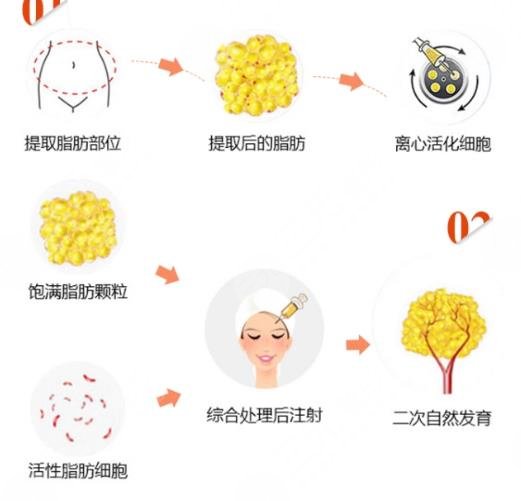 自體脂肪填充面頰具體操作的流程