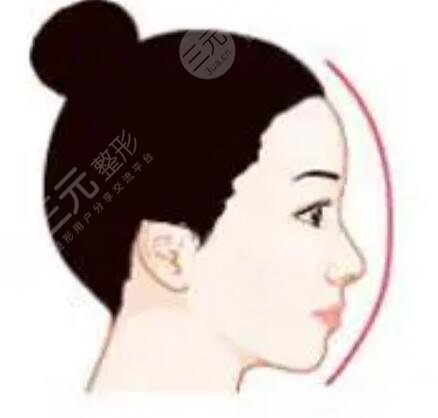 鼻部整形和額頭填充術(shù)對比照
