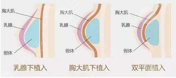 曼托隆胸術(shù)前需準(zhǔn)備什么？